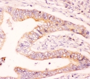 IHC-P: MCL1 antibody testing of human intestine cancer tissue