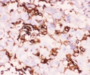 IHC staining of FFPE human intestinal cancer tissue with LFA-1 antibody. HIER: boil tissue sections in pH8 EDTA for 20 min and allow to cool before testing.
