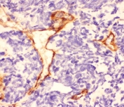 IHC staining of FFPE human lung cancer with Laminin antibody. HIER: boil tissue sections in pH6, 10mM citrate buffer, for 20 min and allow to cool before testing.