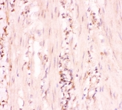 IHC-P: MRP4 antibody testing of human intestinal cancer tissue