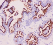IHC-P: MUC1 antibody testing of human ovary cancer tissue