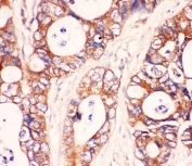 IHC-P: MyD88 antibody testing of human intestine cancer tissue with MyD88 antibody. HIER: boil tissue sections in pH6, 10mM citrate buffer, for 20 min and allow to cool before testing.