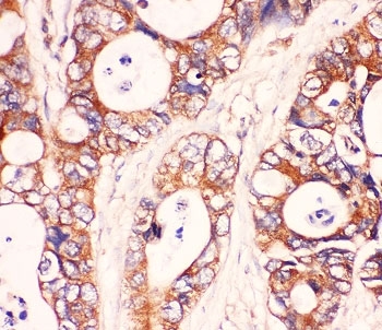 IHC-P: MyD88 antibody testing of human intestine cancer tissue