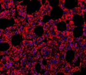 Immunofluorescent staining of human breast cancer with MyD88 antibody (red) and DAPI nuclear stain (blue).