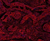 Immunofluorescent staining of human colon cancer with MyD88 antibody (red) and DAPI nuclear stain (blue).
