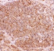 IHC staining of FFPE human lung cancer tissue with NFKB2 antibody. HIER: boil tissue sections in pH8 EDTA for 20 min and allow to cool before testing.