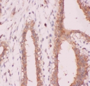 IHC staining of FFPE human breast cancer tissue with NFKB2 antibody. HIER: boil tissue sections in pH8 EDTA for 20 min and allow to cool before testing.