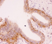 IHC-P: NHE1 antibody testing of human breast cancer tissue