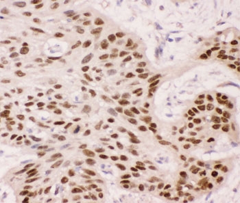 IHC-P: p63 antibody testing of human oesophagus squama cancer tissue~