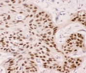 IHC-P: p63 antibody testing of human oesophagus squama cancer tissue