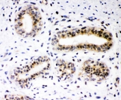 IHC staining of FFPE human breast cancer with RUNX1 antibody. HIER: boil tissue sections in pH6, 10mM citrate buffer, for 20 min and allow to cool before testing.