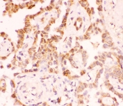 IHC-P: SIRT2 antibody testing of human lung cancer tissue