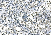 IHC staining of FFPE human lung cancer tissue with BRAF antibody. HIER: boil tissue sections in pH8 EDTA for 20 min and allow to cool before testing.