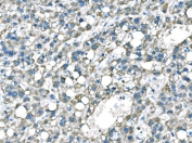 IHC staining of FFPE human liver cancer tissue with BRAF antibody. HIER: boil tissue sections in pH8 EDTA for 20 min and allow to cool before testing.