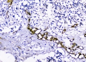 IHC staining of FFPE human glioma tissue with Caveolin-1 antibody. HIER: boil tissue sections in pH8 EDTA for 20 min and allow to cool before testing.