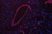 Immunofluorescent staining of FFPE human glioma tissue with Calveolin-1 antibody (red) and DAPI nuclear counterstain (blue). HIER: boil tissue sections in pH8 EDTA buffer for 10-20 min followed by cooling at RT for 20 min.