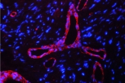 Immunofluorescent staining of FFPE human glioma tissue with Calveolin-1 antibody (red) and DAPI nuclear counterstain (blue). HIER: boil tissue sections in pH6, 10mM citrate buffer, for 10-20 min followed by cooling at RT for 20 min.