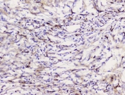 IHC staining of FFPE human meningioma tissue with Caveolin-1 antibody. HIER: boil tissue sections in pH8 EDTA for 20 min and allow to cool before testing.