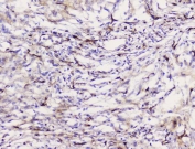 IHC staining of FFPE human meningioma tissue with Caveolin-1 antibody. HIER: boil tissue sections in pH8 EDTA for 20 min and allow to cool before testing.