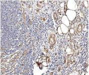 IHC staining of FFPE human rectal cancer with Caveolin-2 antibody. HIER: boil tissue sections in pH8 EDTA for 20 min and allow to cool before testing.