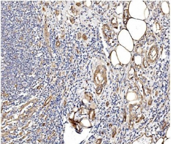 IHC staining of FFPE human rectal cancer with Caveolin-2 antibody. HIER: boil tissue sections in pH8 EDTA for 20 min and allow to cool before testing.