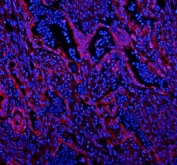 Immunofluorescent staining of FFPE rectal cancer with Caveolin-2 antibody (red) and DAPI nuclear stain (blue). HIER: steam section in pH8 EDTA for 20 min.