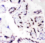 IHC staining of FFPE human placenta with C/EBP beta antibody. HIER: boil tissue sections in pH8 EDTA for 20 min and allow to cool before testing.