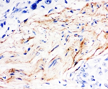 IHC-P: Decorin antibody testing of human breast cancer tissue. HIER: boil tissue sections in pH6, 10mM citrate buffer, for 20 min and allow to cool before testing.~