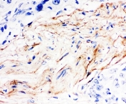 IHC-P: Decorin antibody testing of human breast cancer tissue. HIER: boil tissue sections in pH6, 10mM citrate buffer, for 20 min and allow to cool before testing.