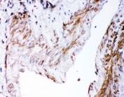 IHC-P: DHFR antibody testing of human lung cancer tissue