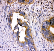 IHC-P: DHFR antibody testing of human lung cancer tissue