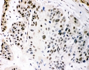 IHC-P staining of human oesophagus squama cancer tissue