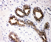 IHC-P: FHIT antibody testing of human breast cancer tissue. HIER: steam section in pH6 citrate buffer for 20 min.