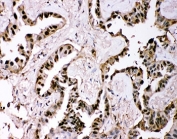IHC-P: GSTP1 antibody testing of human lung cancer tissue. HIER: boil tissue sections in pH8 EDTA for 20 min and allow to cool before testing.