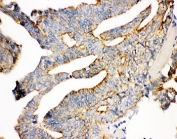 IHC-P: Plakoglobin antibody testing of human intestine cancer tissue. HIER: steam section in pH6 citrate buffer for 20 min.