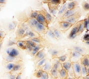 ICC staining of FFPE human MCF7 with Plakoglobin antibody. HIER: boil tissue sections in pH6, 10mM citrate buffer, for 20 min and allow to cool before testing.
