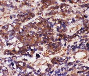 IHC-P: Caspase-3 antibody testing of human lung cancer tissue.