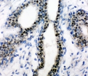 IHC-P: Estrogen Receptor antibody testing of human breast cancer tissue