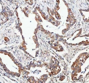 IHC staining of FFPE human pancreatic ductal adenocarcinoma tissue with FOXO3A antibody. HIER: boil tissue sections in pH8 EDTA for 20 min and allow to cool before testing.