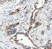 IHC staining of FFPE human pancreatic ductal adenocarcinoma tissue with FOXO3A antibody. HIER: boil tissue sections in pH8 EDTA for 20 min and allow to cool before testing.