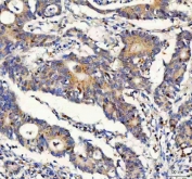 IHC staining of FFPE human colorectal adenocarcinoma tissue with FOXO3A antibody. HIER: boil tissue sections in pH8 EDTA for 20 min and allow to cool before testing.