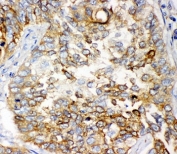 IHC-P: GCLC antibody testing of human lung cancer tissue