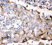 IHC-P: GFRA1 antibody testing of human lung cancer tissue