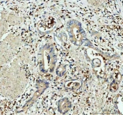 IHC staining of FFPE human colorectal adenocarcinoma tissue with GPX1 antibody. HIER: boil tissue sections in pH8 EDTA for 20 min and allow to cool before testing.