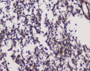 IHC staining of FFPE human glioma with GRIK1 antibody at 1ug/ml. HIER: boil tissue sections in pH6, 10mM citrate buffer, for 10-20 min and allow to cool before testing.