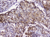 IHC staining of FFPE human lung cancer with GRIK1 antibody at 1ug/ml. HIER: boil tissue sections in pH6, 10mM citrate buffer, for 10-20 min and allow to cool before testing.