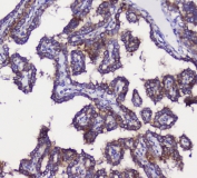 IHC staining of FFPE human thyroid cancer with GRIK1 antibody at 1ug/ml. HIER: boil tissue sections in pH6, 10mM citrate buffer, for 10-20 min and allow to cool before testing.