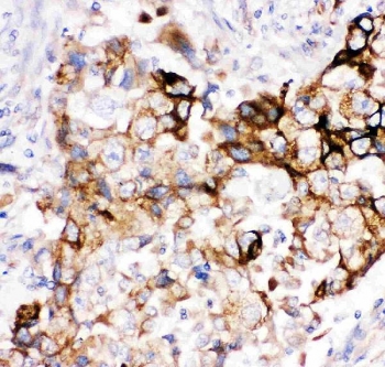 IHC staining of FFPE human lung cancer tissue with Heme Oxygenase 2 antibody. HIER: boil tissue sections in pH6 citrate buffer for 20 min and allow to cool before testing.~