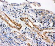 IHC-P: IKKb antibody testing of human lung cancer tissue
