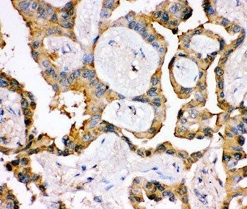 IHC-P: IRS1 antibody testing of human lung cancer tissue